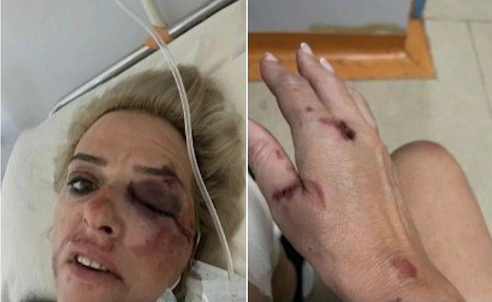 Καλαμάτα: Σοβαρός τραυματισμός γυναίκας από επίθεση σκύλων
